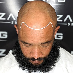 Male Pattern Baldness