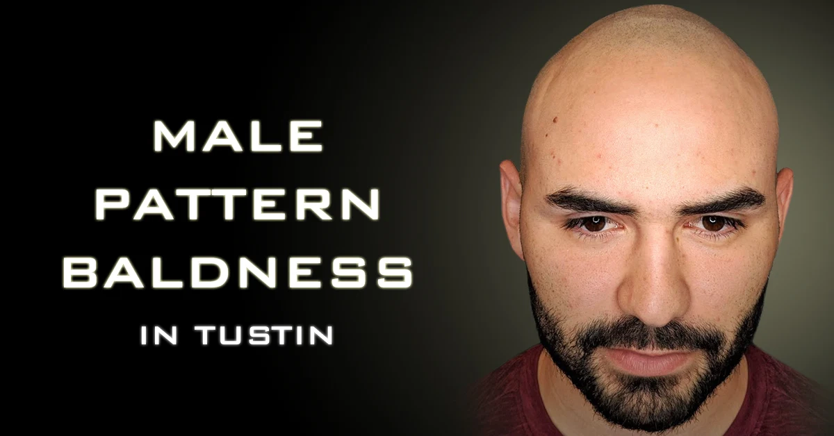 Male pattern baldness Tustin