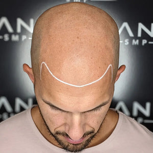 Norwood 7 Male Pattern Baldness Case Study