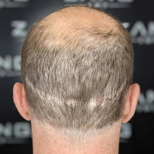Scar Concealment Case Study