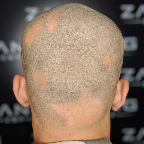 alopecia