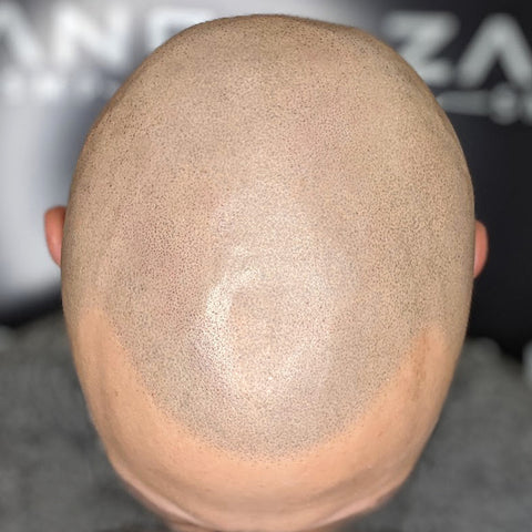 Alopecia