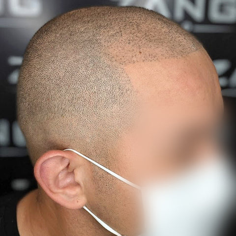Scalp Micropigmentation in India by ABHRS Certified Doctors