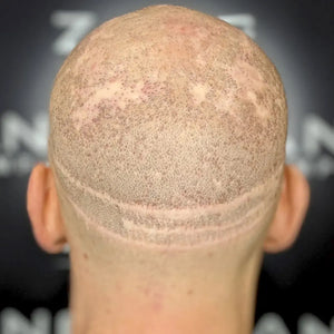 Male Pattern Baldness, Scar Concealment, And Alopecia Case Study