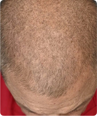 hair-thinning