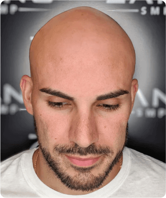 What is male pattern baldness?