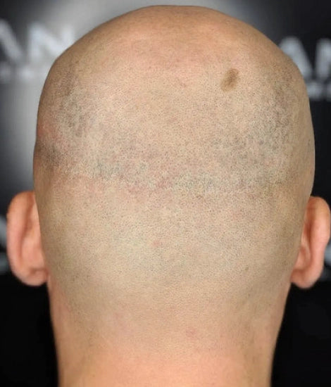 scarring-injuries-img-2